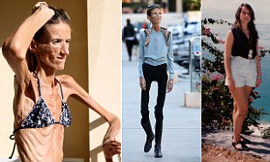 Skinniest People In The World